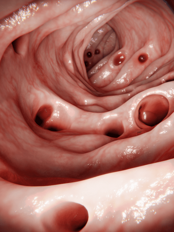 diverticulos en veracruz